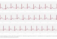 Image result for Normal ECG Apple Watch