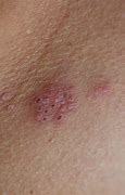 Image result for Unexplained Rashes On Skin