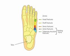 Image result for Jones Fracture Left Foot