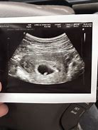 Image result for 6 Weeks 4 Days Pregnant Ultrasound