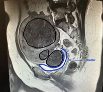 Image result for Uterine Fibroid Pressing On Bladder