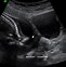 Image result for Anencephaly Spine Ultrasound