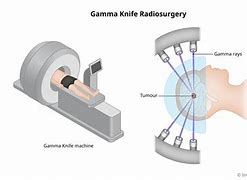 Image result for Gamma Knife Radiation