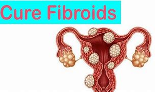 Image result for Real Fibroids