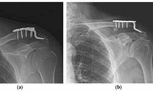 Image result for Hook Plate Shoulder