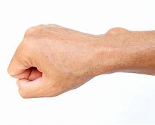 Image result for Lump On My Wrist