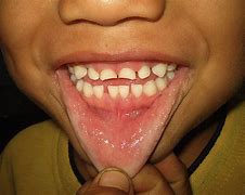 Image result for Verrucous Hyperplasia Tongue