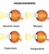 Image result for Myopia Exercises