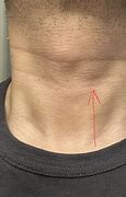 Image result for Bump On Adams Apple