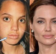 Image result for Angelina Jolie Lip Filler