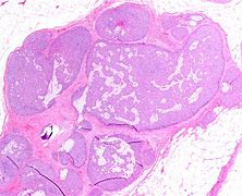 Image result for Tongue Papillary Carcinoma