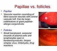 Image result for Conjunctival Papillae