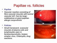 Image result for Folliculitis Eye