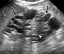 Image result for Cystic Lesion Kidney
