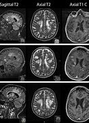 Image result for Multiple Sclerosis Treatment