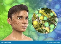 Image result for Chlamydia Trachomatis Bacteria