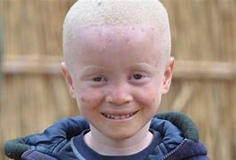 Image result for albinism0
