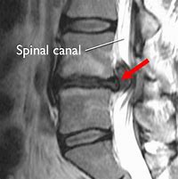 Image result for Herniated Disc Lumbar MRI