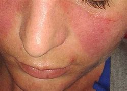 Image result for Yellow Face Cheeks