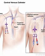 Image result for Central Venous Pressure Catheter