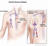 Image result for Tunnelled Central Venous Catheter