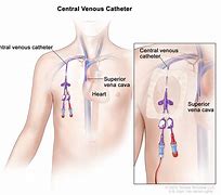 Image result for Central Venous Catheter Cleaning