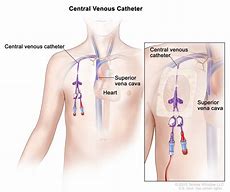 Image result for Cuff Central Venous Catheter