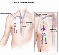 Image result for Central Venous Pressure Catheter