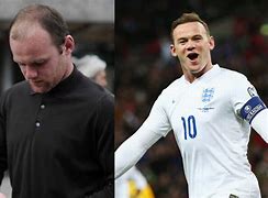 Image result for England Cricket Hair Transplant