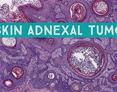 Image result for Adnexal Tumour Skin