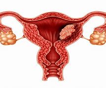 Image result for ca�utero