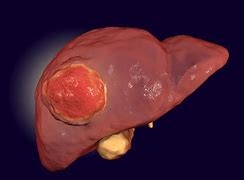 liver cancer 的图像结果