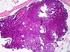 Image result for Papilloma Cytology