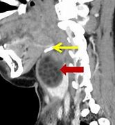 Image result for Dermoid Cyst in Neck