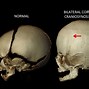 Image result for Coronal Craniosynostosis Pictures