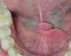 Image result for HPV Tongue Lesion