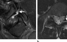 Image result for Axial T2 MRI Pars Defect