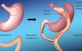 Image result for Roux En Y Gastric Bypass