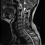 Image result for Cervical Spinal Canal Stenosis