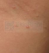 Image result for Molluscum Contagiosum Rash