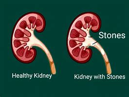 Image result for Passing Kidney Stones