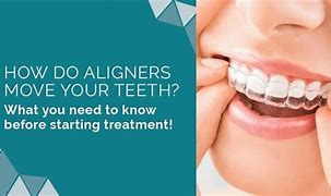 Image result for Byte Aligners Before and After Pictures