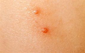 Image result for Does Molluscum Contagiosum Go Away