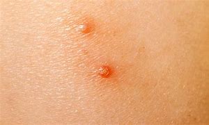 Image result for Molluscum Steroid