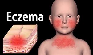 Image result for Severe Ecthyma