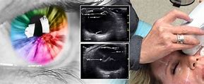 Image result for Ultrasound for Back of Eye