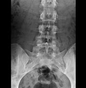 Image result for Spina Bifida S1