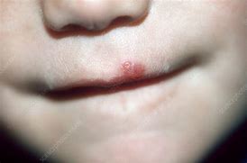 Image result for Molluscum Contagiosum Lips