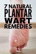 Image result for Plantar Wart Home Remedy