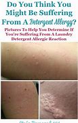 Image result for Allergic Reaction to Detergent